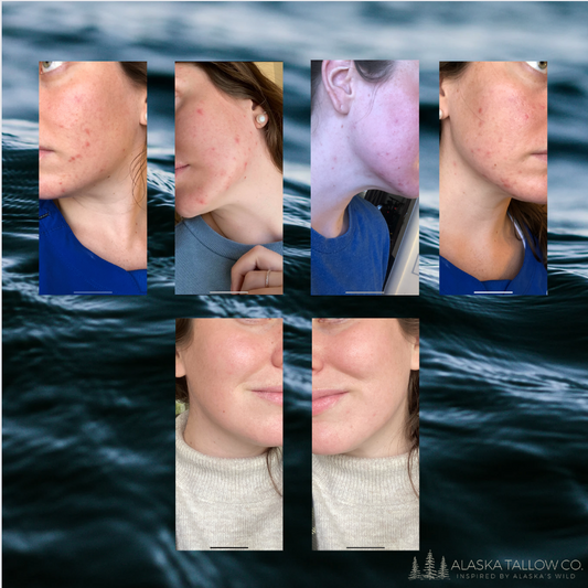 How I healed my acne & how I maintain my skin now